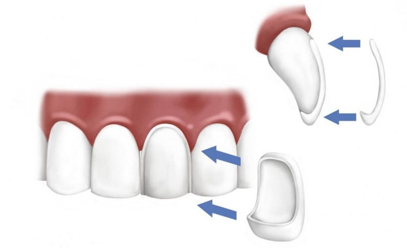 Что такое виниры на зубы