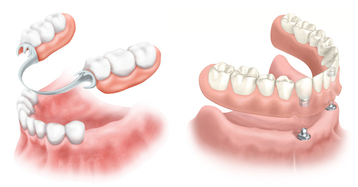 Съемная конструкция протеза на имплантах